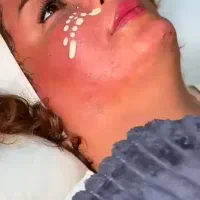 پی آرپی مزو تتوپاک کردن لیزر۱۸۰۰s02