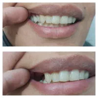 دندانسازی دندان مصنوعی تیکه‌ای هرفک 1تا8 دندان