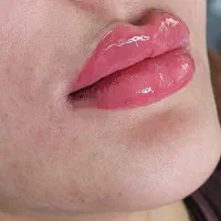بوتاکس فیلر خالبرداری لاغری‌ مزوتراپی