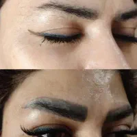 ریموو تتو های قدیمی بدن با دستگاه لیزر کیوسوییچ