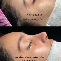 عمل بینی/تمدید تخفیف اخرماه/با پیزو/بدون تامپون/۳۵|خدمات آرایشگری و زیبایی|تهران, دزاشیب|دیوار