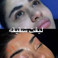 جراحی لیفت دائم شقیقه پیشانی آندوسکوپیک/جراحی بینی