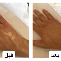 درمان مشکلات پوستی(اگزما-پیسی-پسوریازیس)