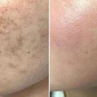 فیبروز ابرو و شیدینگ لب + ریمو تتو و کوکتل‌تراپی
