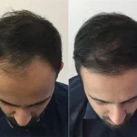 دیگه نگران کچلی نباش