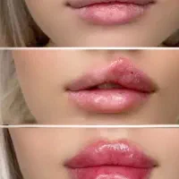 ژل و بوتاکس
