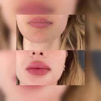 نیازمند مدل برای بوتاکس و فیلر