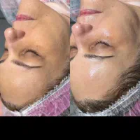 فیشال /پاکسازی /(پلاژن تراپی)تخفیف ویژه بمناسبت