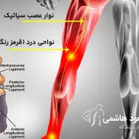 درمان‌۱۰۰درصدسیاتیک باروش TAHGSیاتاج سر