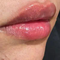 بوتاکس .ژل لب .چونه .گونه