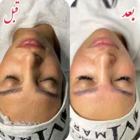 فیشال ، پاکسازی پوست ، فیشیال ، جوانسازی ، لیفت