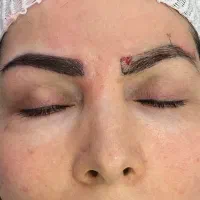 کاشت ابرو