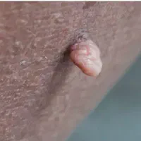 درمان قطعی و ریشه ای زگیل و تبخال