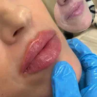 آموزش تخصصی بوتاکس، فیلر، فیشیال