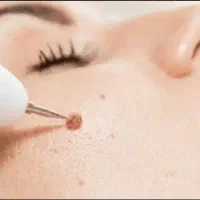 تخفیف ویژه ی برداشتن خال و لک و کک ومک و زگیل