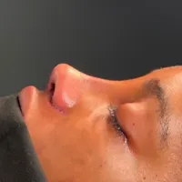 جراحی بینی،لیپو ابدو و ترنسفر ،بلفارو، پروتز سینه