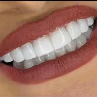 دندان مصنوعی کامپوزیت لمینت روکش