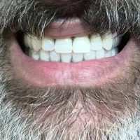 دندانسازی‌شروین/کروم‌کبالت/اوردنچر/دندان‌مصنوعی