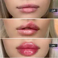 آموزش تخصصی فیلر و بوتاکس بدون عوارض