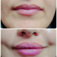 تزریق فیلر وبوتاکس و مزوتراپی و مزوژل و پاکسازی