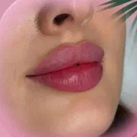 ژل لب بوتاکس،فیلر مطب کلینیک زیبایی جوانسازی