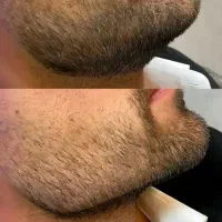 ژل  وبوتاکس