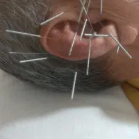 آموزش طب سوزنی ، درمان بیماریها با طب سوزنی