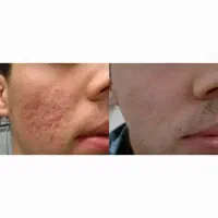 پاسازی صورت،رفع کک،مک دو جلسه درکلینیک سهندوتبریز