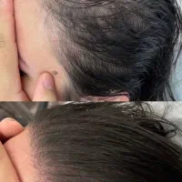 قطع ریزش و جلوگیری از طاسی