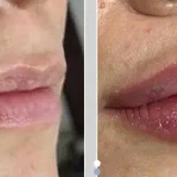 فیلر بوتاکس