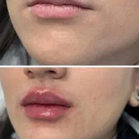 فیلر|خدمات آرایشگری و زیبایی|تبریز, |دیوار