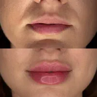 بهترین خدمات زیبایی ژل بوتاکس فیلر مزوژل لیزر|خدمات زیبایی و سلامت|شیراز, ارم|دیوار