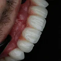 راهکار دائمی برای دندان از دست رفته