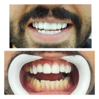 ایمپلنت اقساطی با طرح وام دندانپزشکی متخصص فک صورت