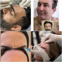 بوتاکس با شرایط اقساطی  کلینیک کاوه