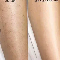 آفر ویژه لیزر موهای زائد (ویژه بانوان)