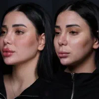 ژل بوتاکس فیلر چشم لب گونه مزوتراپی فشیال خانم اقا