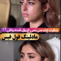فیلر لب مزو ژل بوتاکس با ۸۰٪ تخفیف به مدت محدود
