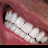 کامپوزیت دندان با قیمت باورنکردنی و تخفیف ویژه