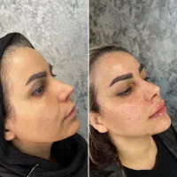 فیلر بوتاکس توسط پزشک زیبایی