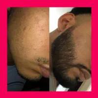 خداحافظی با ریش کم پشت
