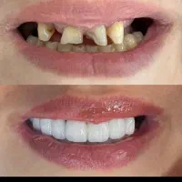 تخفیفات کامپوزیت ،لمینت