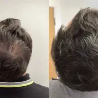 میدونستی که کف سر چرب باعث ریزش میشه