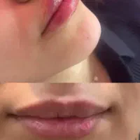 جشنواره تخصصی بوتاکس  فیلر و زاویه‌سازی در کلینیک