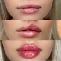 مطب پزشک.ژل وبوتاکس.لیفت بانخ.فیلربینی