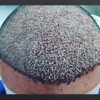 توضیحات بخون کاشت ابرو تخصصی و موی سر