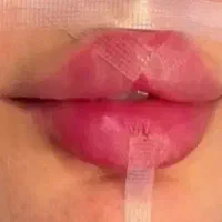 خدمات ژل وبوتاکس