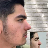 عمل بینی با دستگاه پیزوسرجری با تخفیف ۵۰درصد
