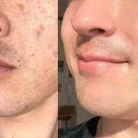 سرم بیوممتیک