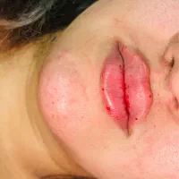 فیلروپیرسینگ وپی ارپی